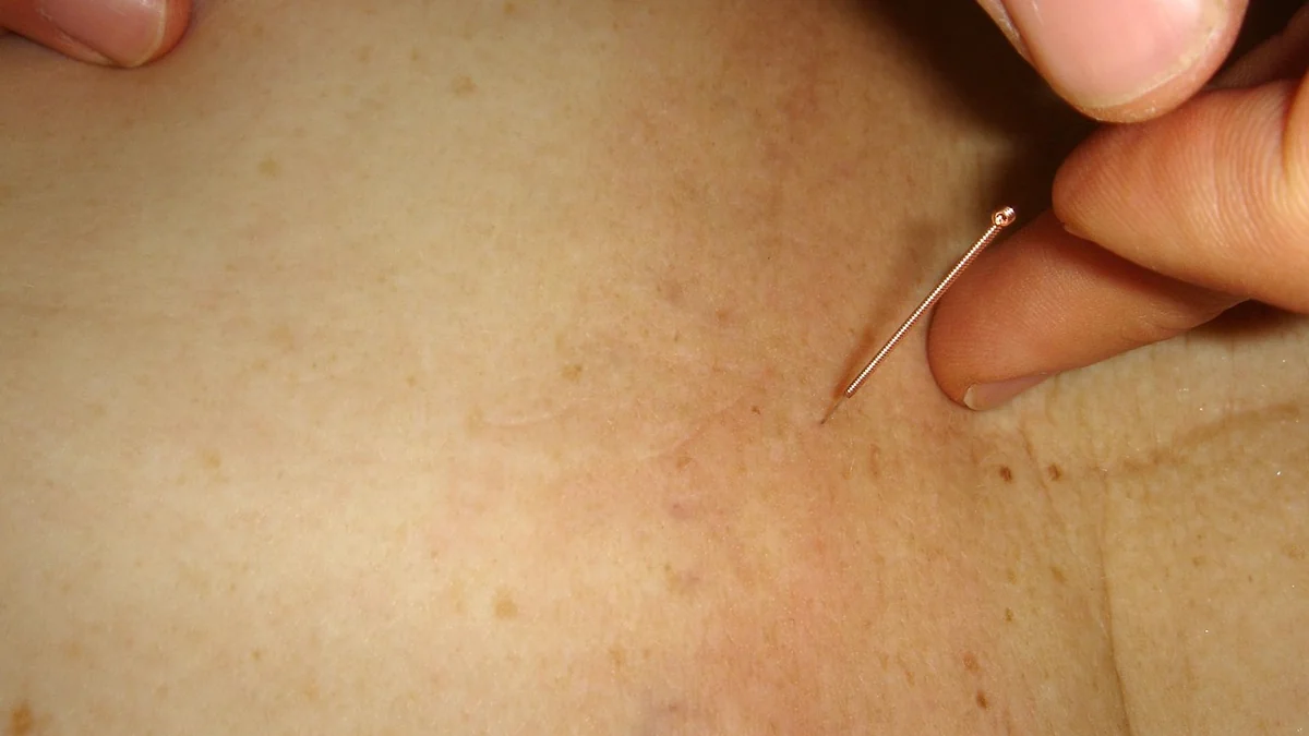 Medecine traditionnelle chinoise et acupuncture